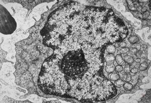 F,51y. | blood - chronic lymphatic leukemia … prolymphocyte F,51y. | blood - chronic lymphatic leukemia … prolymphocyte